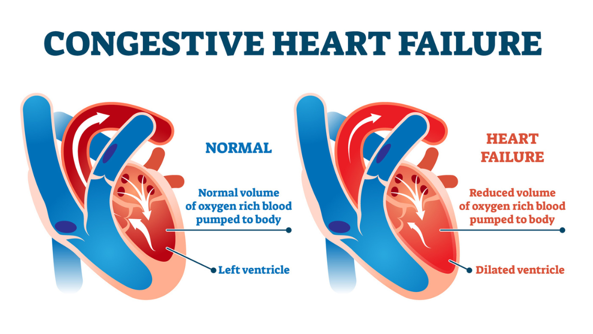 heart-failure-nursing-ce-course-for-aprns-85e96c61-8937-4a51-bafc-289e0d03aac3