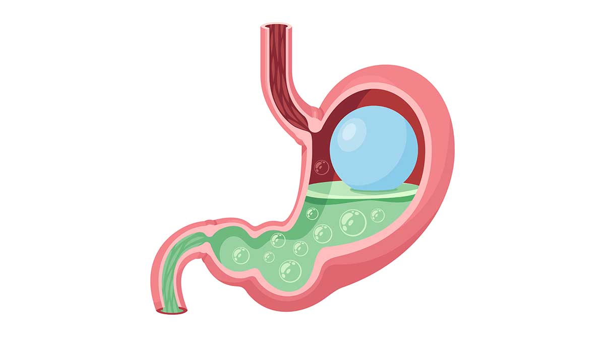 bariatric-surgery-nursing-ce-course-bcb222ec-eaa4-4329-9a4b-e91785d255a2
