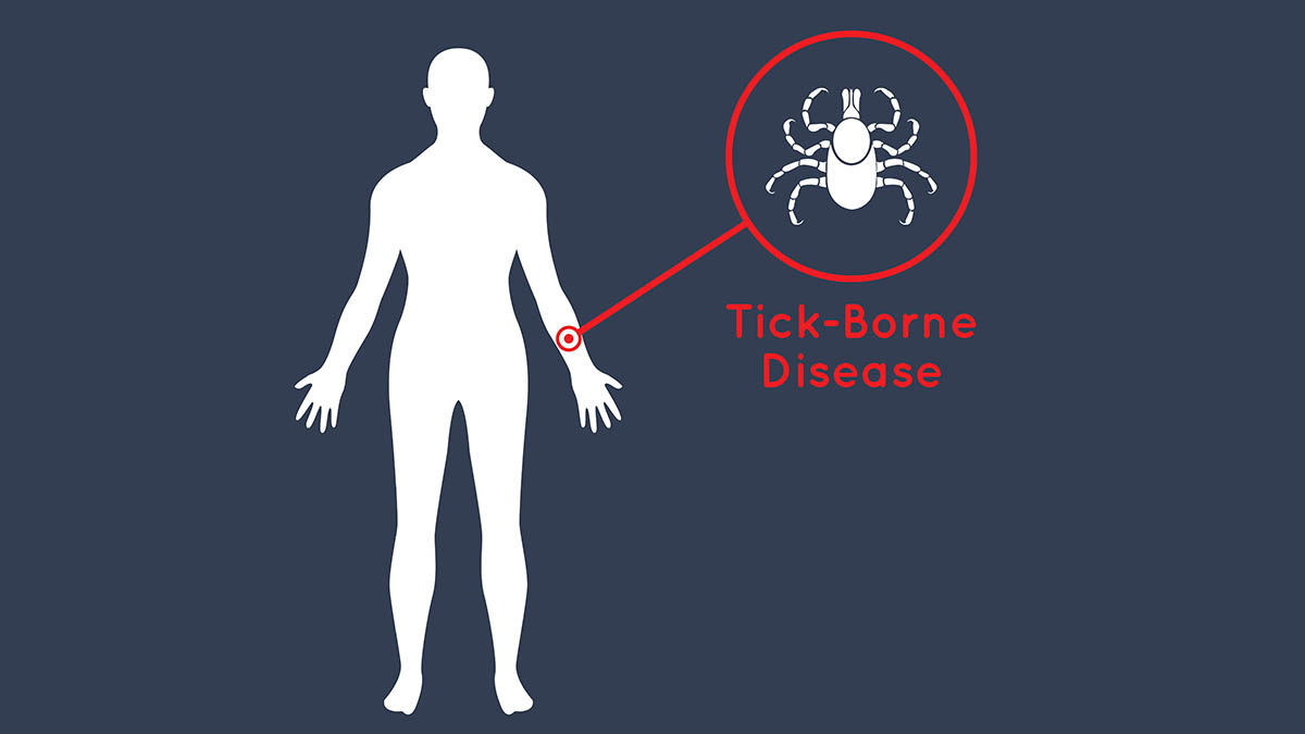 tickborne-diseases-nursing-ce-course-for-aprns-78d07e4e-a38d-4653-9da2-aa063b0e83fa
