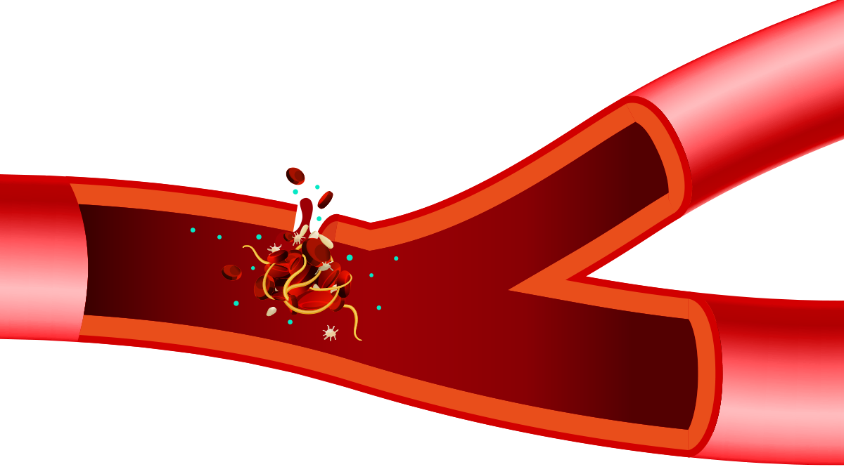 blood-clotting-disorders-aprn