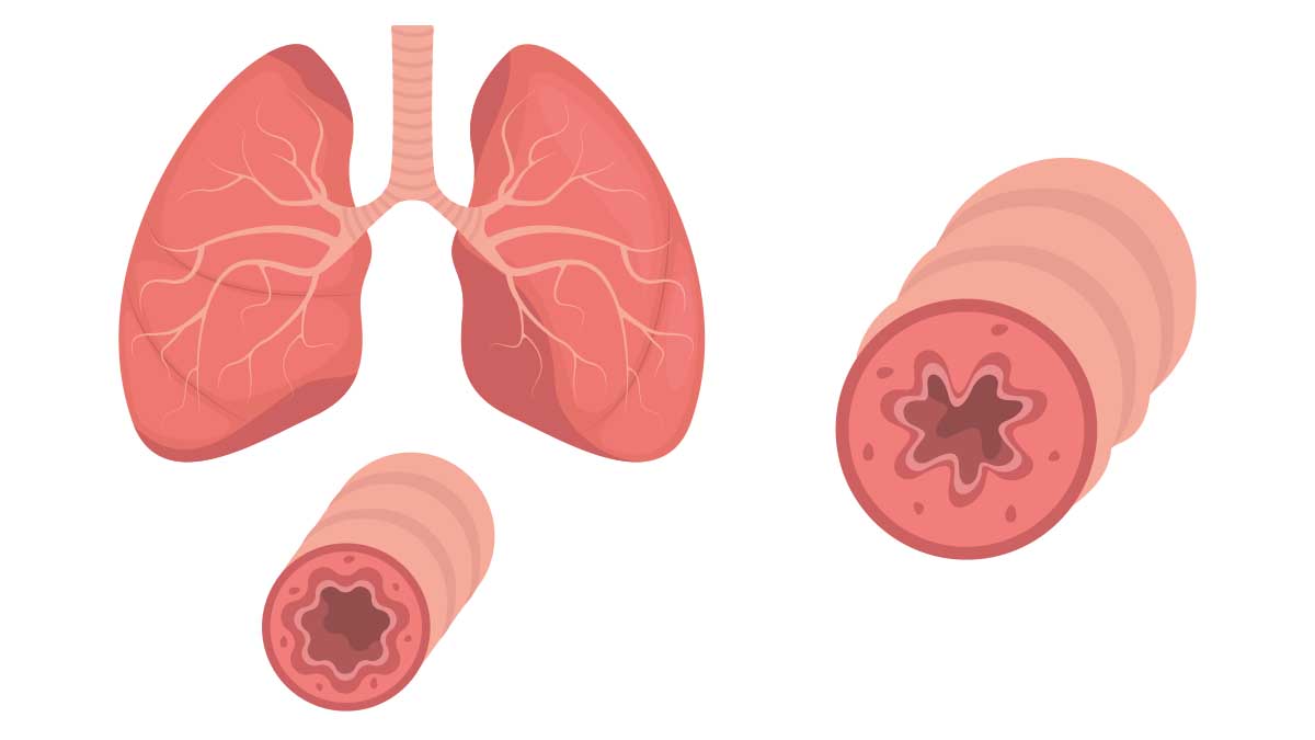 asthma-pathophysiology