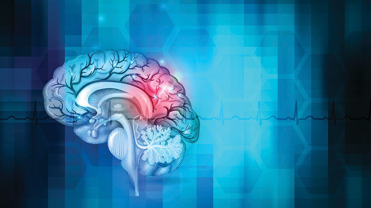stroke-prevention-thrombolytic-therapy-and-rehab