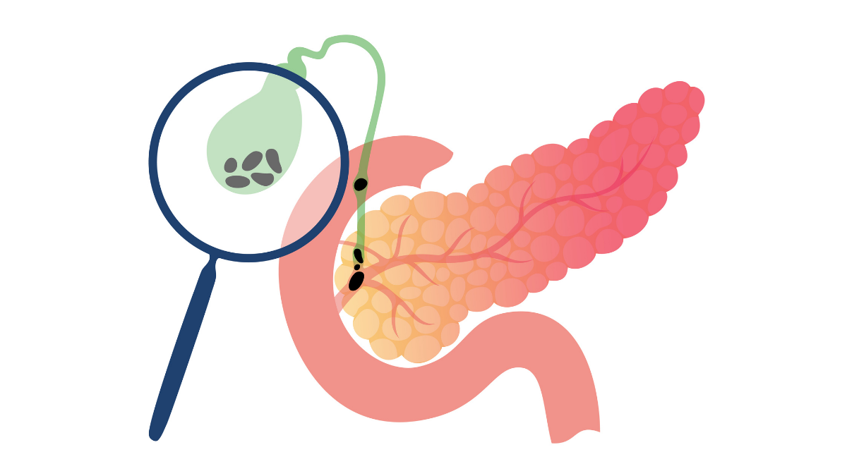 pancreatic-cancer-aprn
