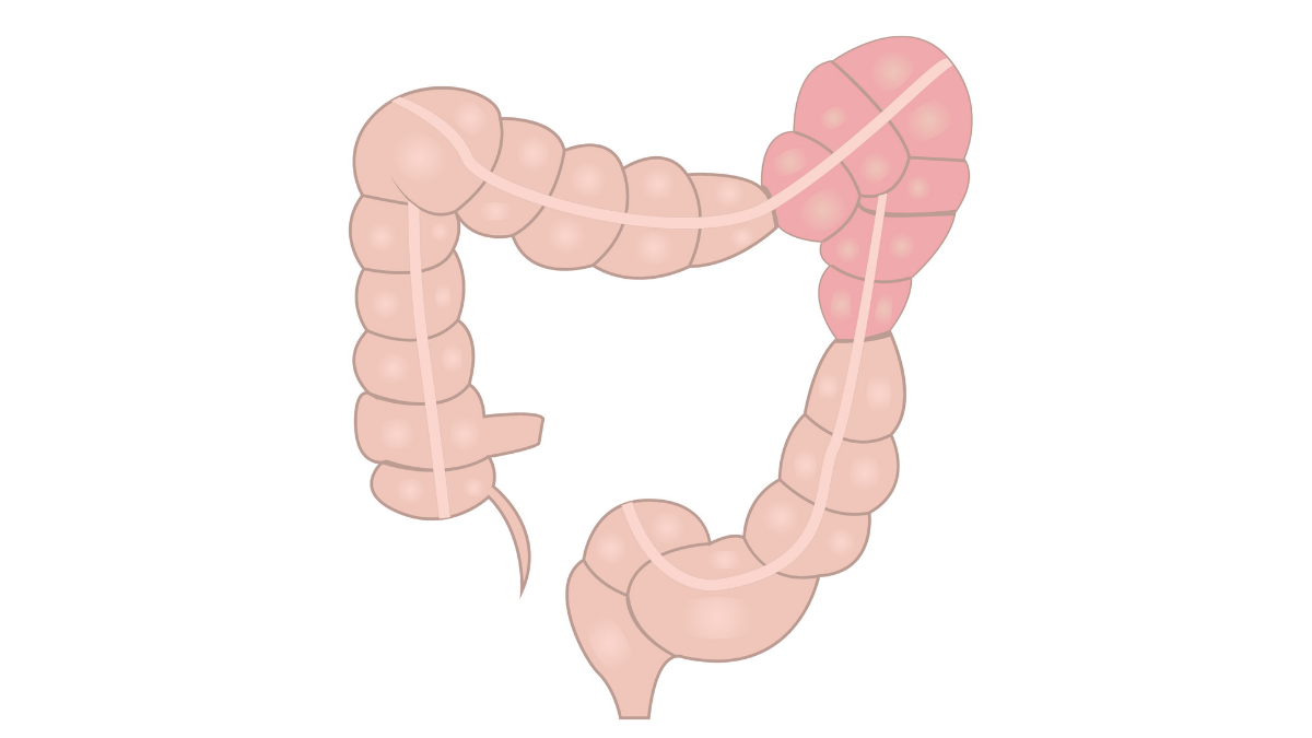 irritable-bowel-syndrome-aprn