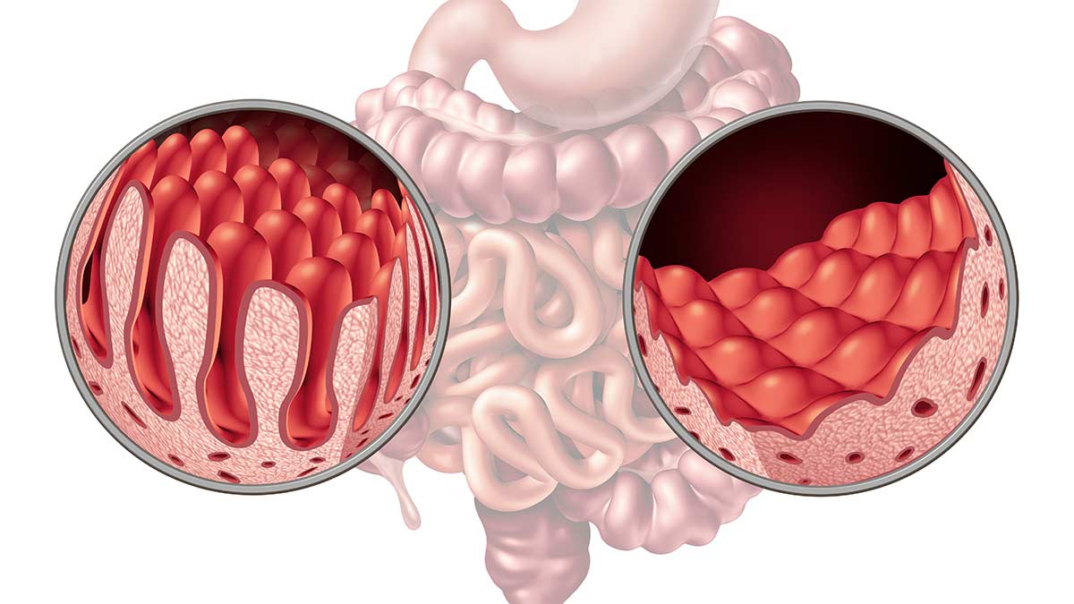 Celiac Disease Nursing CE Course NursingCE