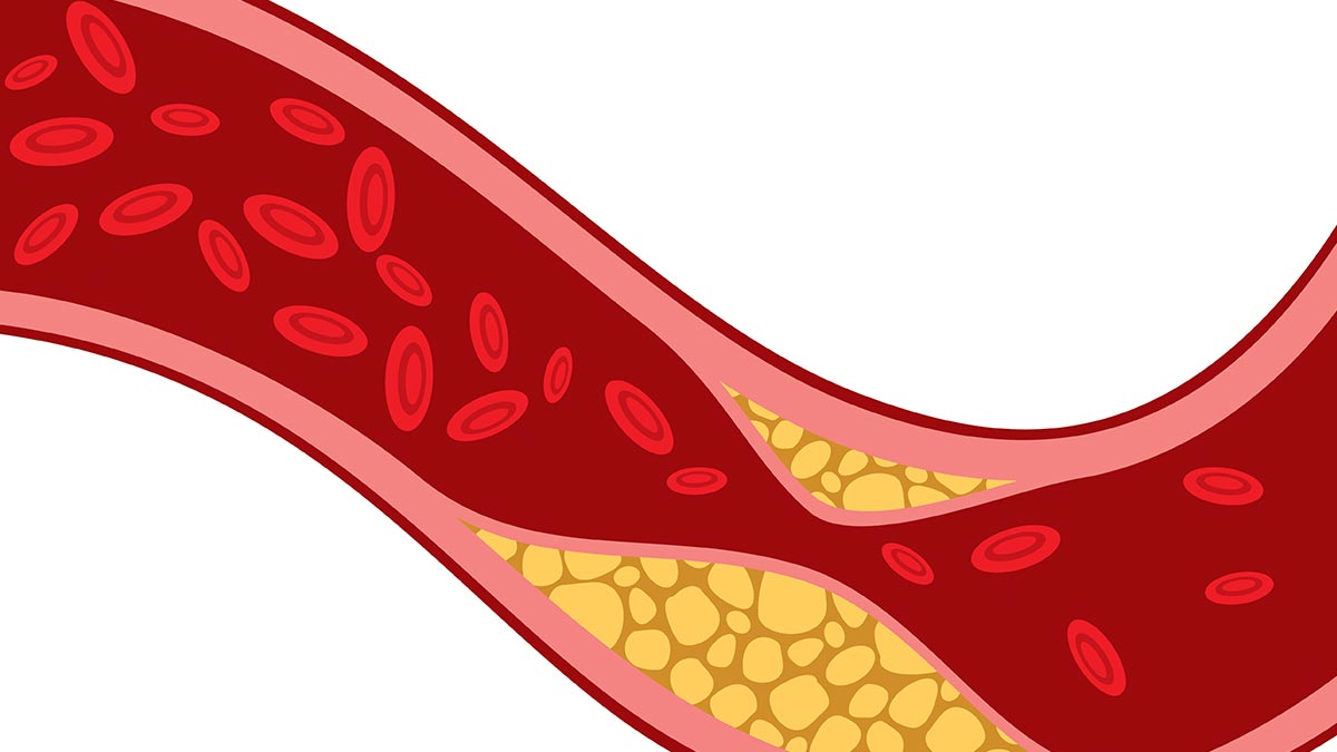 cholesterol