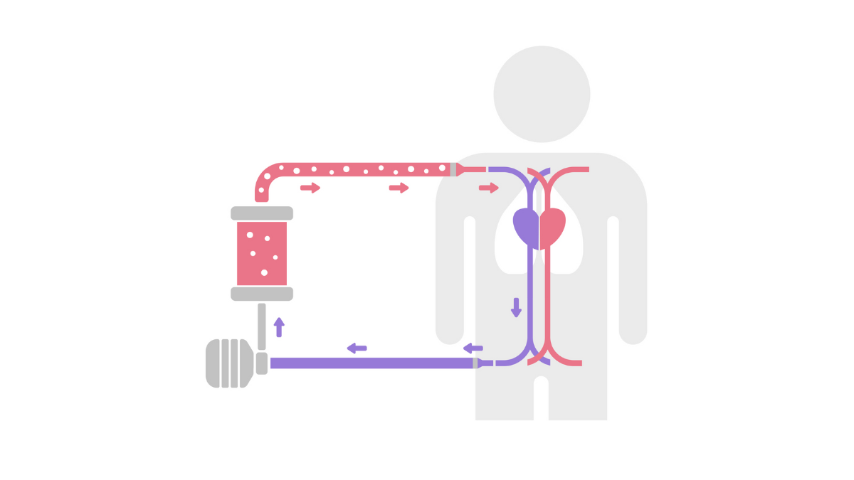 extracorporeal-membrane-oxygenation-nursing-ce-course
