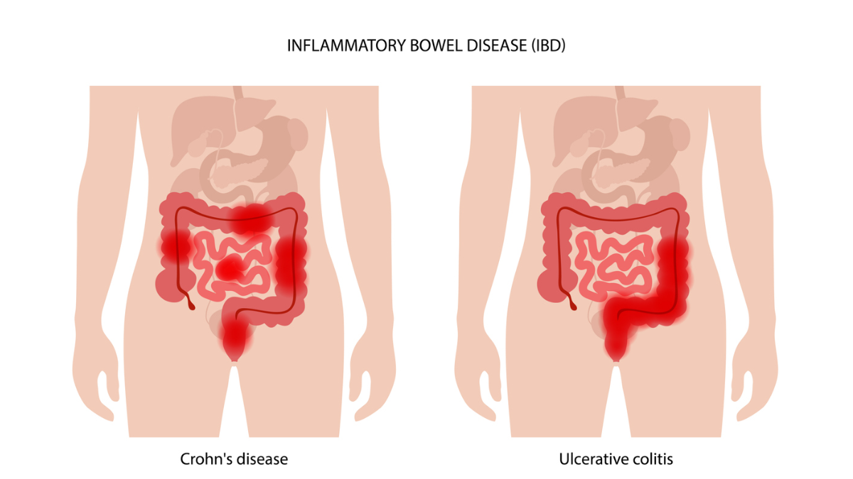 inflammatory-bowel-disease-nursing-ce-course-for-aprns